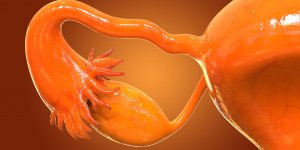 Cancer des ovaires : les personnes les plus a risques