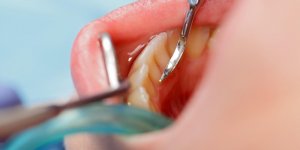 Dechaussement dentaire : le role meconnu du tartre