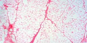 Diabete : chaque kilo de graisse viscerale en plus multiple vos risques par 7