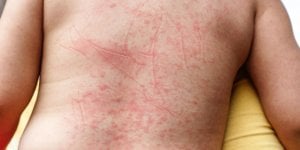 Purpura : taches rouges sur la peau, que se passe-t-il ? 