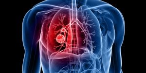Ses mains “veloutees” etaient le signe d’un cancer du poumon
