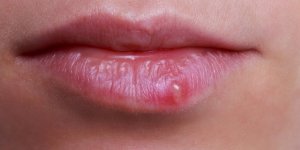 Herpes labial : les conseils d’une patiente pour l’eviter et le soigner en ete