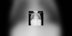 Pneumopathie : les inquietudes