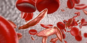 Anemie par carence martiale : les symptomes