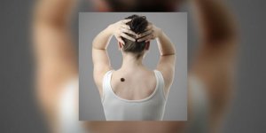 Angiome : pourquoi et comment traiter ?