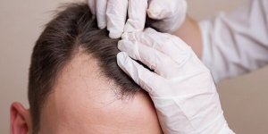Greffe de cheveux en Turquie et en France : les prix et meilleures cliniques 