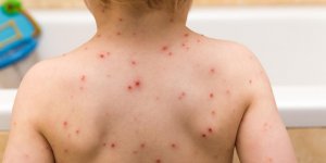 Boutons rouges : comment savoir si c-est une maladie infantile ?