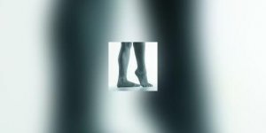Hallux valgus, ou plus communement " oignon "