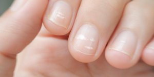 A cause de la chimiotherapie, les ongles d’un homme sont devenus marrons