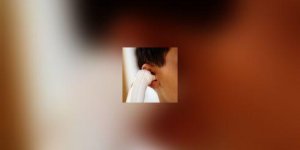 Otite de l-enfant : antibiotiques ou pas ?