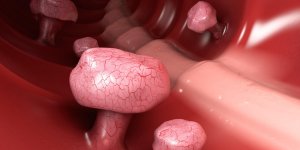 Polypes : symptomes, risques et traitement