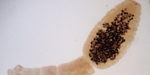 Dijon : une femme infectee par un tenia au niveau des vertebres