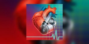 Deuxieme implantation de cœur artificiel