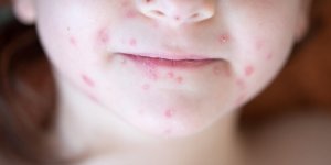 Plusieurs regions touchees par une epidemie de varicelle