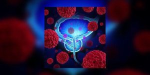 Cancer localise de la prostate : faut-il traiter ou pas ?