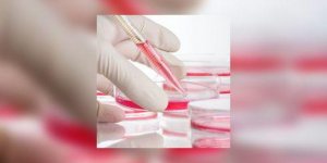 Myelome multiple, un nouveau traitement prometteur ?