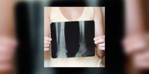 Le cancer augmente le risque d’osteoporose, y compris celui du col et de l-endometre…