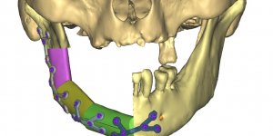 Lyon : des chirurgiens utilisent la 3D pour reconstruire une machoire