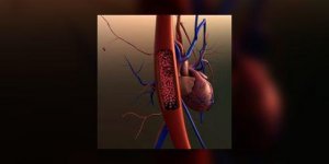 Accident vasculaire cerebral : un drone miniature pour deboucher l-artere obstruee