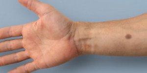 Cancer : un grain de beaute artificiel capable de detecter les premiers signes