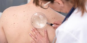 Cancer de la peau : ces 5 signes qui doivent inquieter