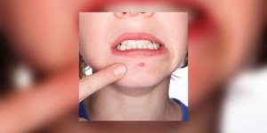 Eruptions Cutanees Herpes Zona Varicelle Allergie Cutanee Eruptions Cutanees Herpes Zona Varicelle Allergie Cutanee