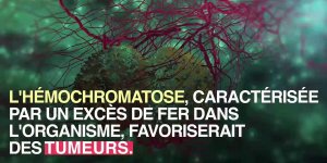 Exces de fer et risque de cancer : un lien ?