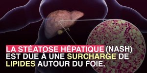 Maladie du foie : comment le sucre peut jouer un role dans certaines cirrhoses