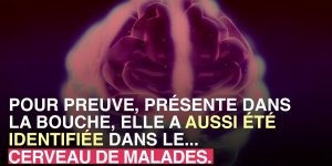 Saignement des gencives et maladie d-Alzheimer : un lien ?