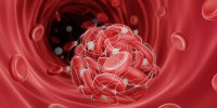 Thrombose veineuse : des facteurs de risque identifiés chez la femme