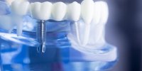 5 choses que vous ne savez pas sur les couronnes dentaires