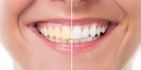 Comment obtenir des dents plus blanches en quelques minutes par jour ?