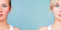 Rosacée : quels traitements pour s'en débarrasser ?