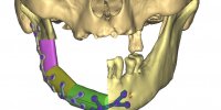 Lyon : des chirurgiens utilisent la 3D pour reconstruire une mâchoire