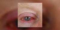 Irritation de l'oeil 