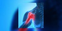 Douleur aux articulations (polyarthralgie)