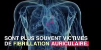 Les migraines avec aura augmenteraient le risque d'AVC
