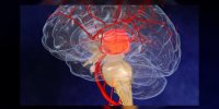 L'accident vasculaire cérébral expliqué en vidéo