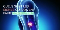 Cancer du pancréas : les 3 premiers symptômes