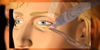 La chirurgie esthétique des yeux expliquée en vidéo