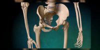 L'arthroplastie de la hanche (prothèse de hanche) expliquée en vidéo