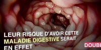 Les personnes atteintes de psoriasis seraient plus à risque de maladie de Crohn