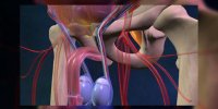 La hernie inguinale expliquée en vidéo