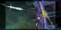 Injections spinales