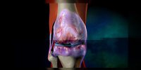 L'arthroplastie du genou expliquée en vidéo
