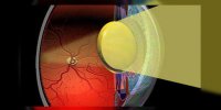 Implants oculaires