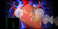 La fibrillation auriculaire expliquée en vidéo