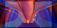 Incontinence fécale