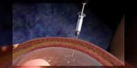 L'amniocentèse expliquée en vidéo