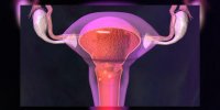 L'endométriose expliquée en vidéo